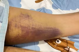 Người phụ nữ ở Phan Thiết nghi bị gia đình chồng cũ bạo hành 