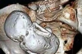 Thai nhi nằm trong bụng suốt 35 năm mà mẹ không hay biết