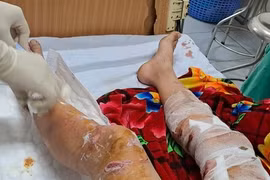 Lào Cai: Nam sinh phải nhập viện vì bị chó thả rông cắn 