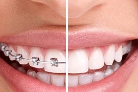 Hiểm họa từ trào lưu niềng răng bằng kéo và keo