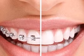 Hiểm họa từ trào lưu niềng răng bằng kéo và keo