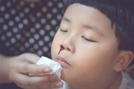 Xử trí chảy máu cam trong thời tiết lạnh 