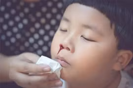 Xử trí chảy máu cam trong thời tiết lạnh 