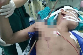 Cứu nam công nhân bị thanh sắt đâm xuyên nách