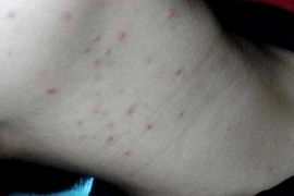 'Chấm đỏ nhỏ' mọc ở bộ phận này, cố gắng đi kiểm tra sức khỏe 