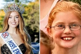 Hoa hậu Anh từng bị bắt nạt vì ngoại hình kỳ quặc