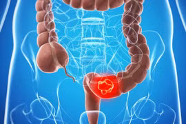 Dấu hiệu này cảnh báo bạn mắc ung thư, đừng xem nhẹ 