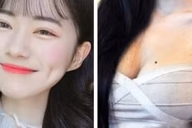 Lý do má lúm đồng tiền, nốt ruồi trước ngực nhất định phải giữ gìn 