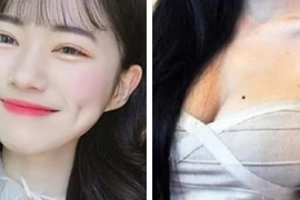 Lý do má lúm đồng tiền, nốt ruồi trước ngực nhất định phải giữ gìn 