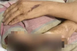 Nhiễm trùng nặng do chữa bỏng bằng cách nhiều người thường làm