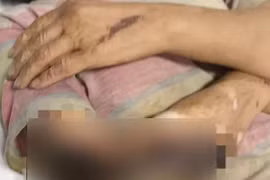 Nhiễm trùng nặng do chữa bỏng bằng cách nhiều người thường làm