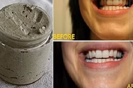 Học cách tự chế kem đánh răng chữa sâu răng hiệu quả