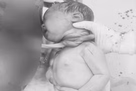 Hy hữu: Sinh xong mới biết con bị dây rốn quấn cổ 3 vòng