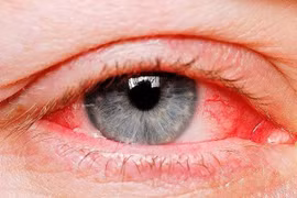 Làm gì khi đi chơi Tết bất ngờ bị đau mắt đỏ? 