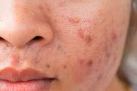 Làm sao chữa dứt điểm mụn trứng cá?