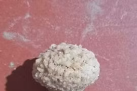 Sỏi bàng quang vì thường xuyên nhịn tiểu