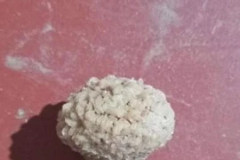 Sỏi bàng quang vì thường xuyên nhịn tiểu