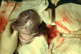 Cách phát hiện khối u buồng trứng