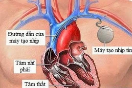 Lưu ý trong sinh hoạt sau cấy máy tạo nhịp