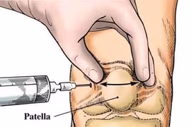 Tiêm Acid hyaluronic chữa thoái hóa khớp