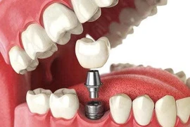 Mất răng và cấy ghép implant