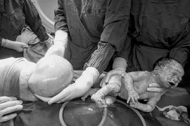 Một bé trong đôi song sinh chào đời nguyên bọc ối