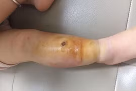 Viêm mô tế bào nguy hiểm