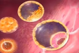  Không mang thai bị ung thư nhau thai