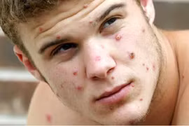 Bỉ áp dụng cách ly bắt buộc đối với người mắc đậu mùa khỉ