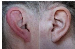 Đỏ tai và đau nửa đầu