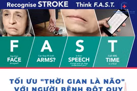  Lệch mặt do đột quỵ lại tưởng liệt dây thần kinh