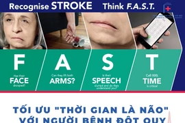  Lệch mặt do đột quỵ lại tưởng liệt dây thần kinh