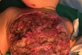 Hoại tử bụng và ngực vì đắp lá chữa bỏng