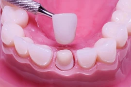 Thử sườn trước khi lắp răng sứ