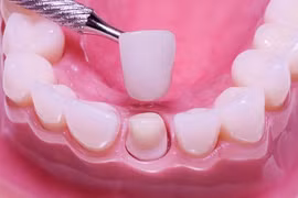 Thử sườn trước khi lắp răng sứ