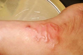 Lấy xong ổ giun lươn đã hết bệnh?