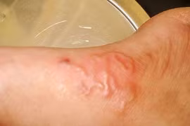 Lấy xong ổ giun lươn đã hết bệnh?