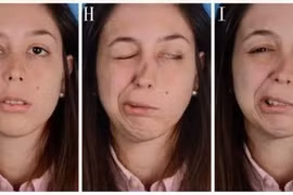 Méo miệng, liệt mặt vì thức khuya