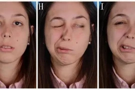 Méo miệng, liệt mặt vì thức khuya