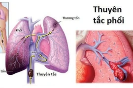 Thuyên tắc huyết khối tĩnh mạch - “kẻ sát nhân thầm lặng”