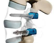 Phương pháp điều trị xẹp đốt sống nặng do loãng xương