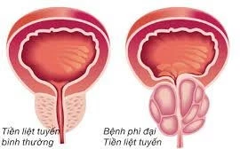 Tự chữa bí đái thành suy thận