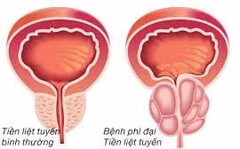 Tự chữa bí đái thành suy thận