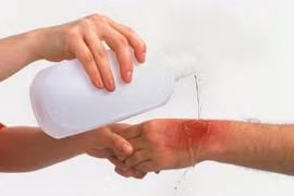 Xử lý khi bị sứa cắn