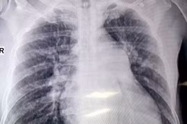 Đau ngực đột ngột cẩn thận tắc mạch phổi