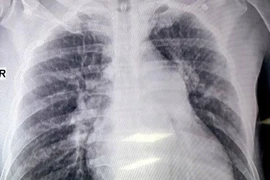 Đau ngực đột ngột cẩn thận tắc mạch phổi