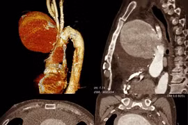 Chỉ phù mặt người đàn ông “thoát chết” vì phình động mạch chủ “khổng lồ”