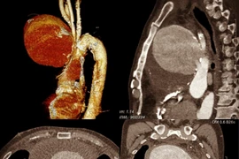 Chỉ phù mặt người đàn ông “thoát chết” vì phình động mạch chủ “khổng lồ”
