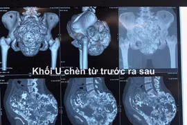 Khối u khủng gây teo thận