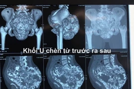 Khối u khủng gây teo thận